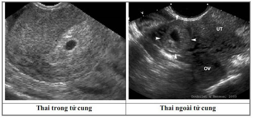Xuất huyết tử cung bất thường có nguy hiểm không Xuất huyết tử cung bất thường có nguy hiểm không